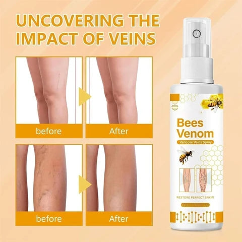 Bee Venom Spider Veins Spray (Pack of 2) – Bee Venom & Vitamin K Based Skin Comfort Formula