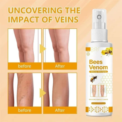 Bee Venom Spider Veins Spray (Pack of 2) – Bee Venom & Vitamin K Based Skin Comfort Formula