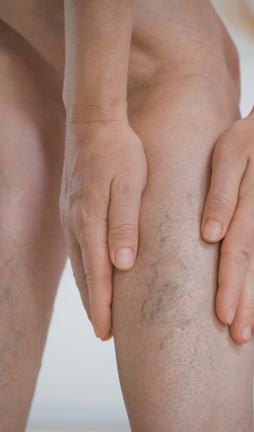 Vein Healing Varicose Veins Care Spray 50ml (Pack of 2) – Cooling & Soothing