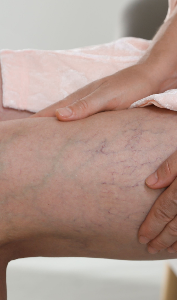 Vein Healing Varicose Veins Care Spray 50ml (Pack of 2) – Cooling & Soothing