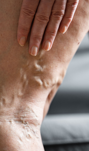 Vein Healing Varicose Veins Care Spray 50ml (Pack of 2) – Cooling & Soothing