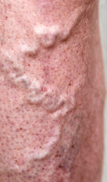 Vein Healing Varicose Veins Care Spray 50ml (Pack of 2) – Cooling & Soothing