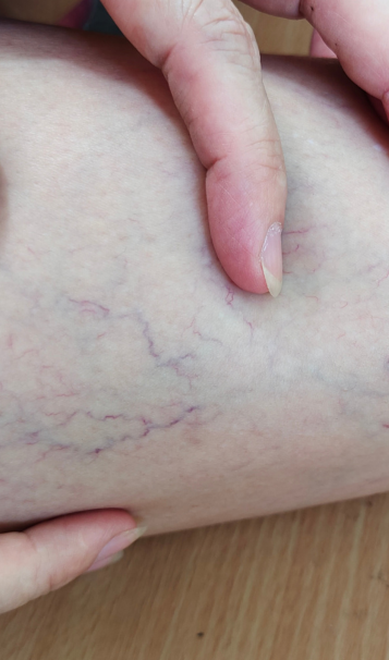 Vein Healing Varicose Veins Care Spray 50ml (Pack of 2) – Cooling & Soothing