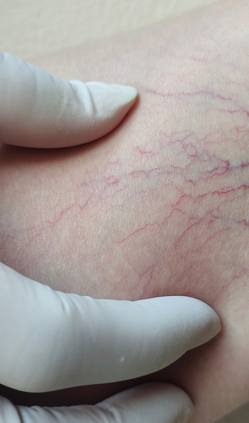 Vein Healing Varicose Veins Care Spray 50ml (Pack of 2) – Cooling & Soothing