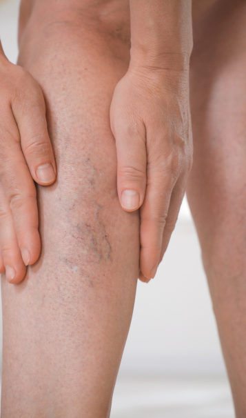 Vein Healing Varicose Veins Care Spray 50ml (Pack of 2) – Cooling & Soothing