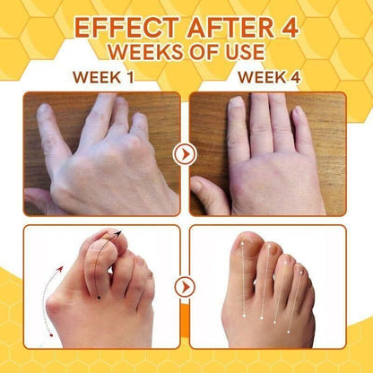 Bee Venom Spider Veins Spray (Pack of 2) – Bee Venom & Vitamin K Based Skin Comfort Formula