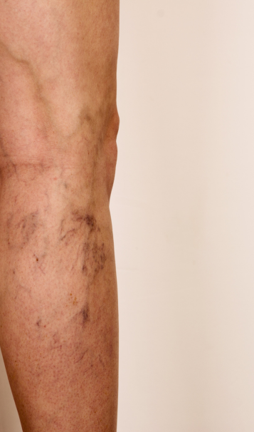 Vein Healing Varicose Veins Care Spray 50ml (Pack of 2) – Cooling & Soothing