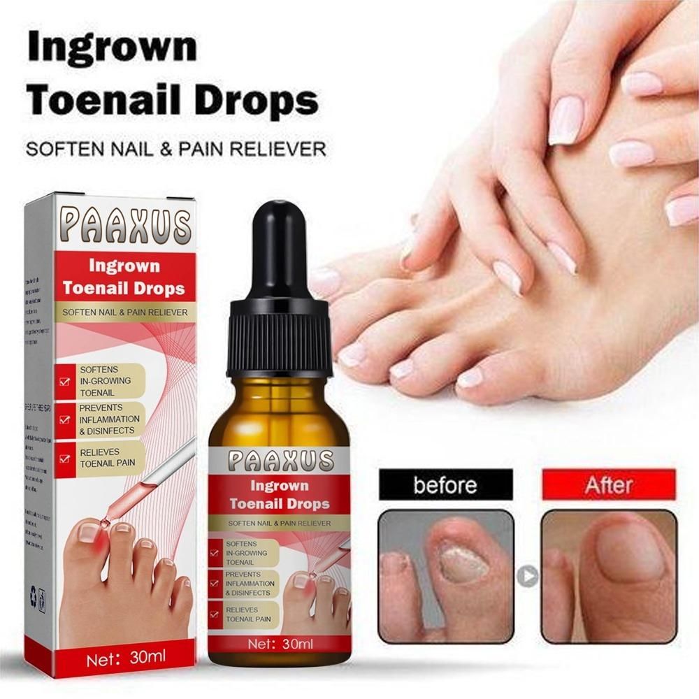 Ingrown Toenail Care Drops 60ml (Pack of 2) – Nail Care Solution