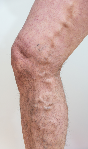 Vein Healing Varicose Veins Care Spray 50ml (Pack of 2) – Cooling & Soothing