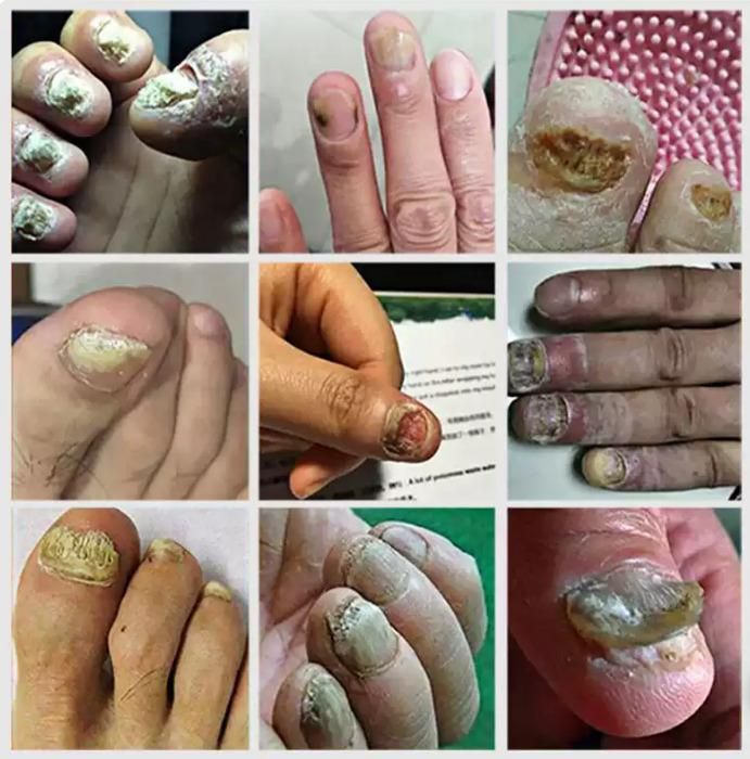 Ingrown Toenail Care Drops 60ml (Pack of 2) – Nail Care Solution