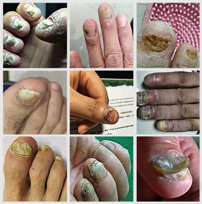 Ingrown Toenail Care Drops 60ml (Pack of 2) – Nail Care Solution