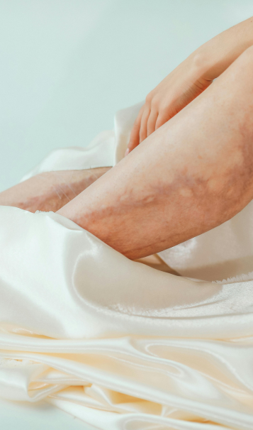 Vein Healing Varicose Veins Care Spray 50ml (Pack of 2) – Cooling & Soothing