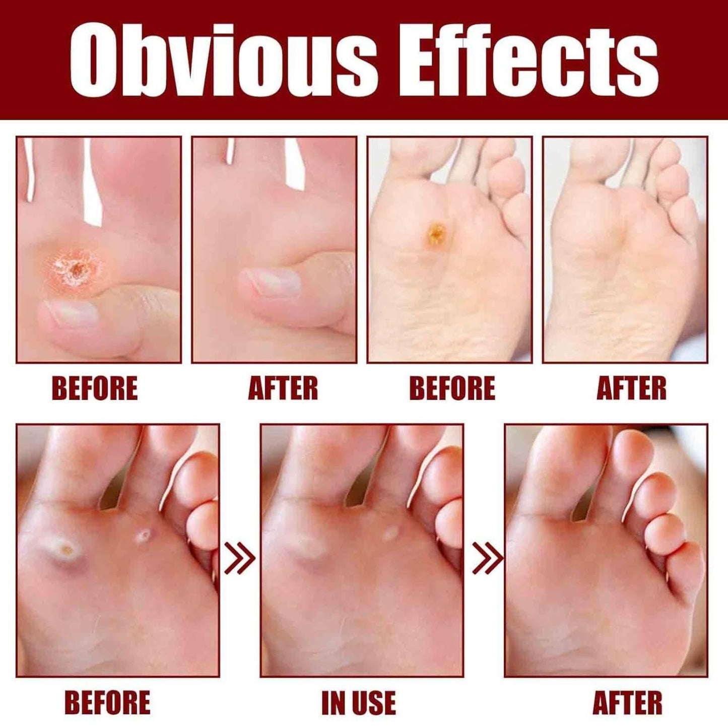 Feet Corn Removal Serum 30ml – Liquid Foot Care for Hard Skin, Cracked Heels & Corn Support (Pack of 1)