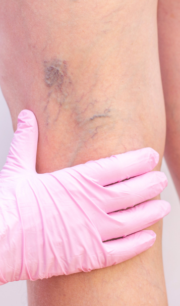 Vein Healing Varicose Veins Care Spray 50ml (Pack of 2) – Cooling & Soothing