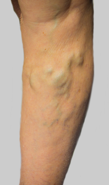 Vein Healing Varicose Veins Care Spray 50ml (Pack of 2) – Cooling & Soothing